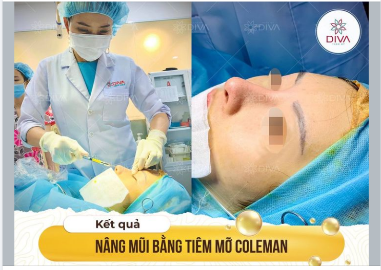 KẾT QUẢ THẨM MỸ SAU CẤY MỠ COLEMAN MŨI