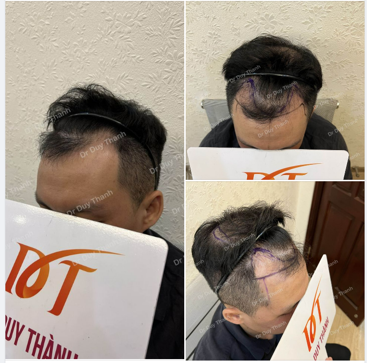 CHUẨN BỊ CẤY 1700 NANG, BOY BIÊN HÒA 34 TUỔI