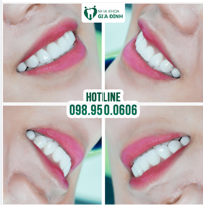 SỨC MẠNH CỦA NỤ CƯỜI NẰM Ở CHÍNH HÀM RĂNG CỦA BẠN