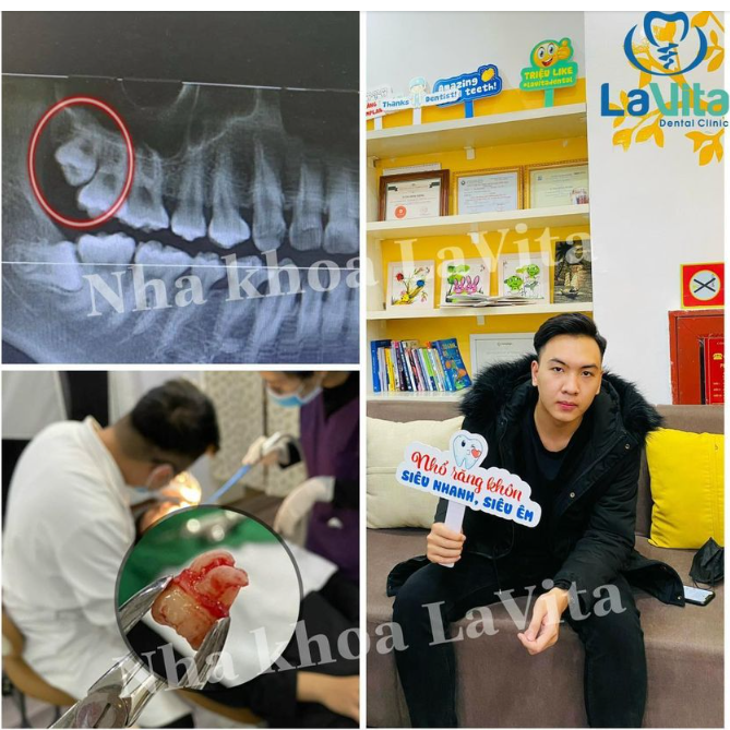 Phương pháp này đặc biệt an toàn cho răng, nhẹ nhàng, hạn chế tối đa sưng đau.