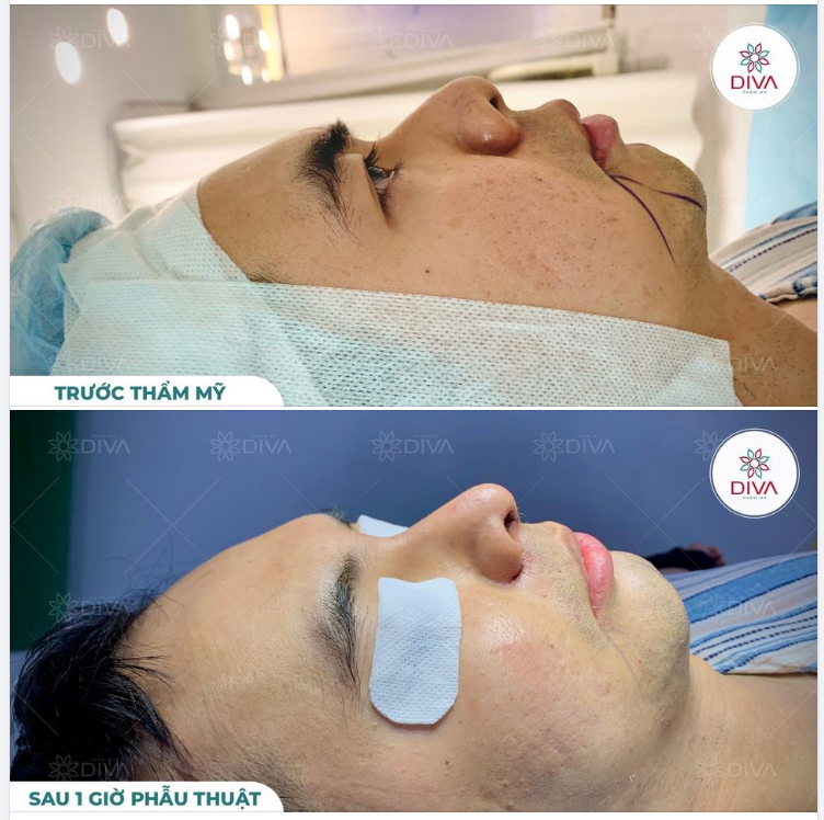 Năm qua bạn mong muốn sở hữu dáng mũi mới: đẹp và ấn tượng hơn nhưng chưa kịp?