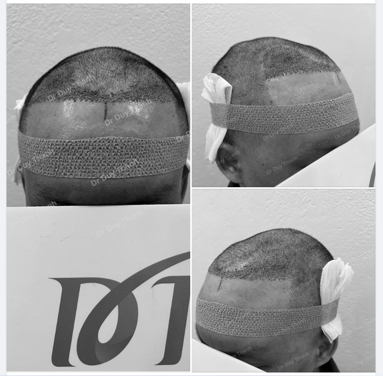 TRẢ KẾT QUẢ CẤY 1700 NANG TÓC, BOY BIÊN HÒA 34 TUỔI