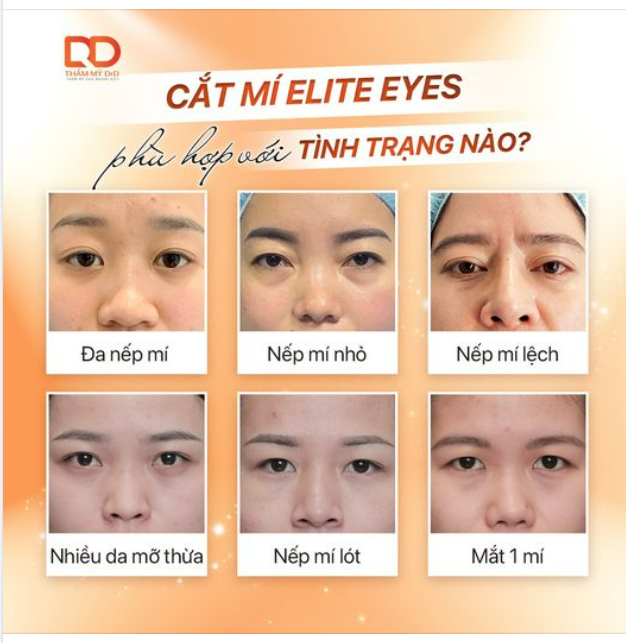 MẮT CÓ KHUYẾT ĐIỂM NÀO, SỬA NGAY KHUYẾT ĐIỂM ĐÓ