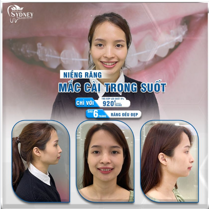 Ưu điểm của mắc cài pha lê