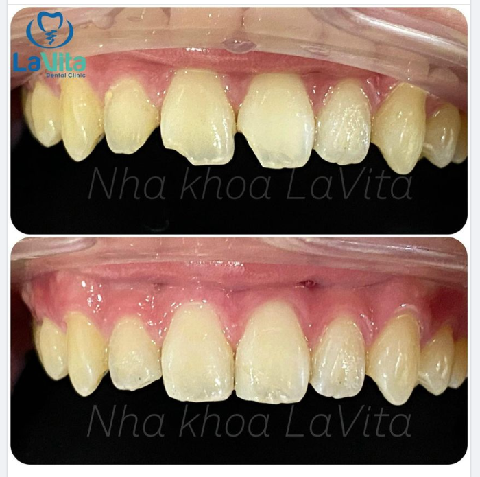 Phương pháp này được thực hiện khá nhanh chóng, đơn giản bằng chất hàn nha khoa chuyên dụng, có màu sắc y hệt như răng thật, không hề bị lộ trong quá trình giao tiếp.