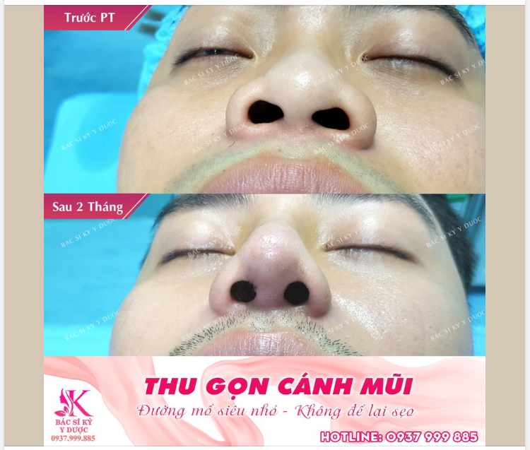 Thu gọn cánh mũi cho Anh khách dễ thương