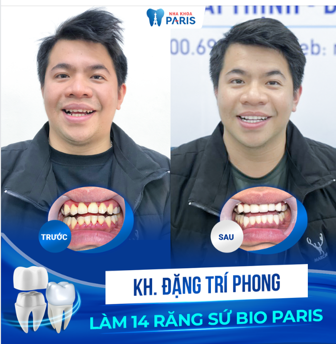 BỌC SỨ KHAI XUÂN - ĐÓN LỘC VẸN Ý