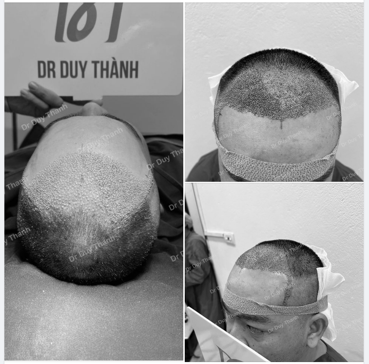 TRẢ KẾT QUẢ SAU CẤY 2000 NANG TÓC- BOY KIÊN GIANG