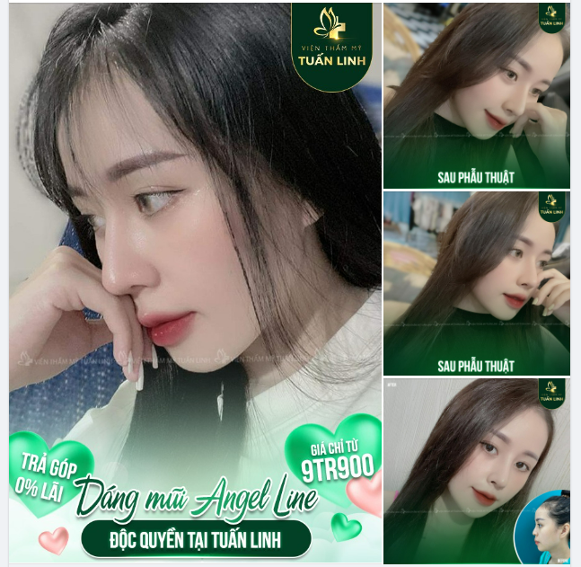 Sở hữu dáng mũi Angel Line độc quyền tại Tuấn linh với giá chỉ từ 9TR900.