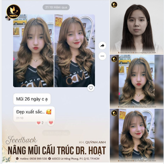 FEEDBACK NÂNG MŨI SỬA LẠI CỦA NÀNG 9X VIỆT KIỀU MỸ