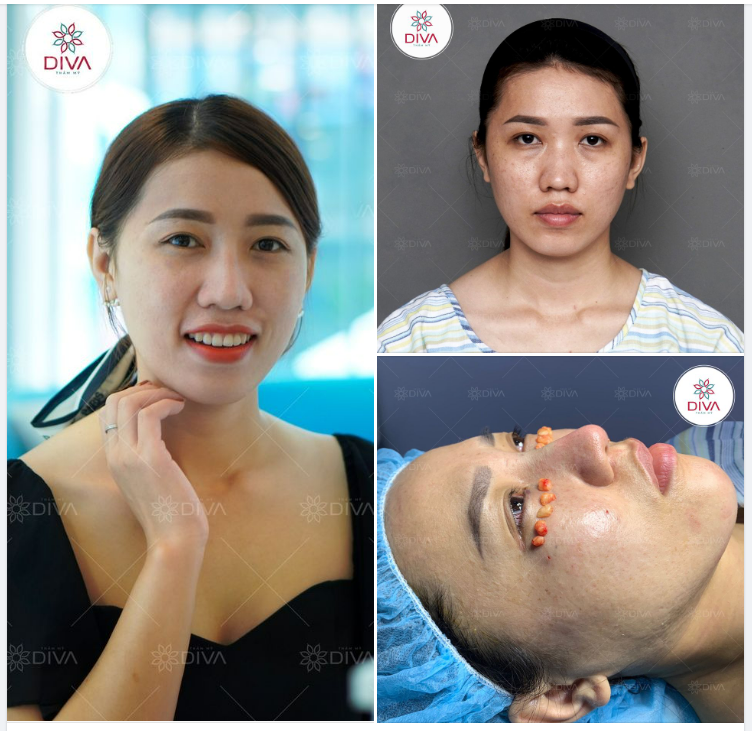 ĐẸP TỰ NHIÊN, CÂN ĐỐI VÀ CUỐN HÚT SAU 3 TUẦN NÂNG MŨI, CẤY MỠ, LẤY MỠ MÍ DƯỚI