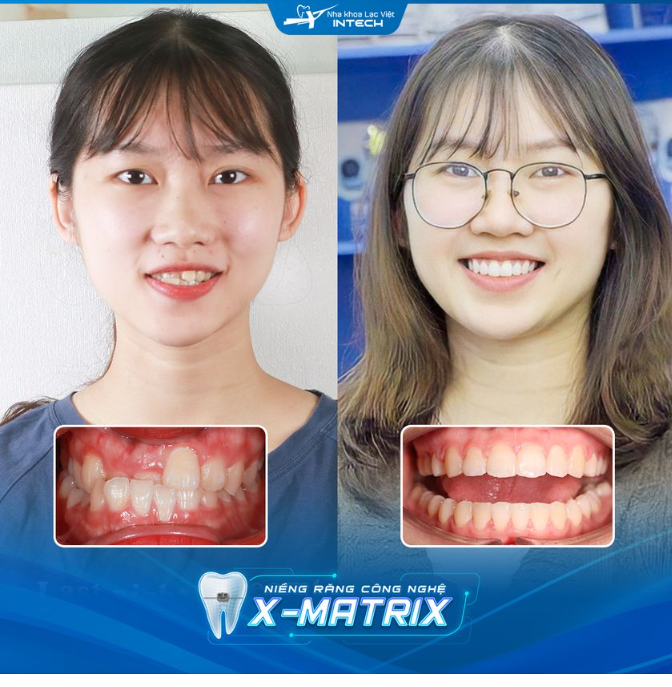 THAY ĐỔI NỤ CƯỜI, NÂNG TẦM NHAN SẮC NHỜ NIỀNG RĂNG X-MATRIX
