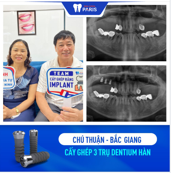 Nha khoa Paris tự hào là trung tâm xử lý case khó và phẫu thuật cấy ghép Implant không gây đau đớn, khó chịu cho khách hàng.