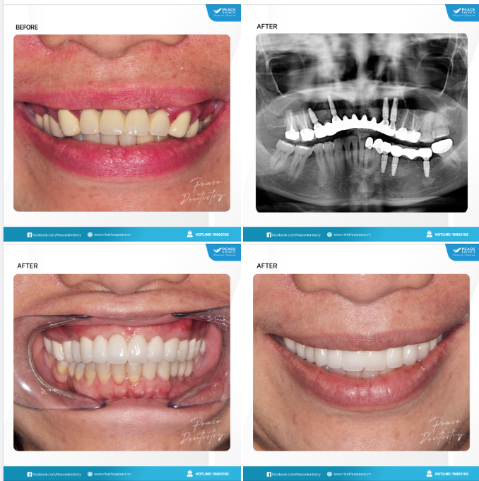 Ca lâm sàng  trồng răng implant thay thế cho các cầu răng sứ dài đã xuống cấp trầm trọng