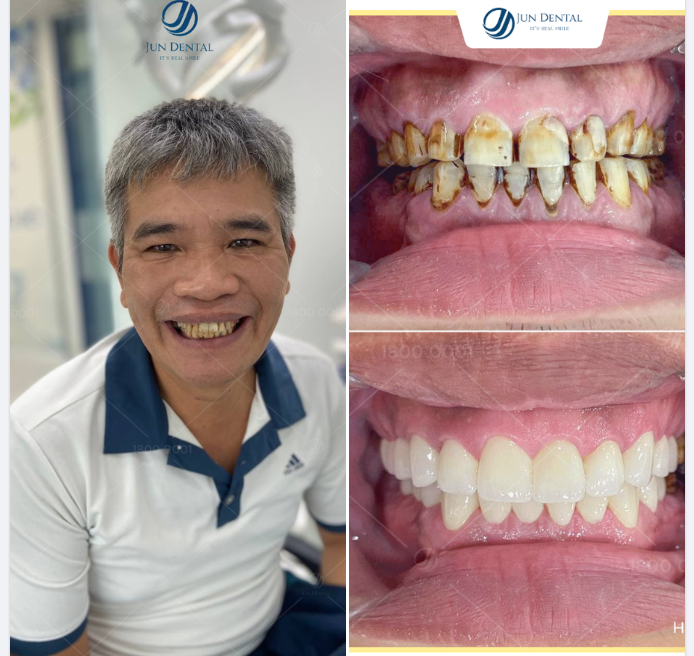 DÁNG RĂNG MẠNH MẼ ĐẦY NAM TÍNH NHỮNG VẪN GIỮ NGUYÊN NÉT TỰ NHIÊN