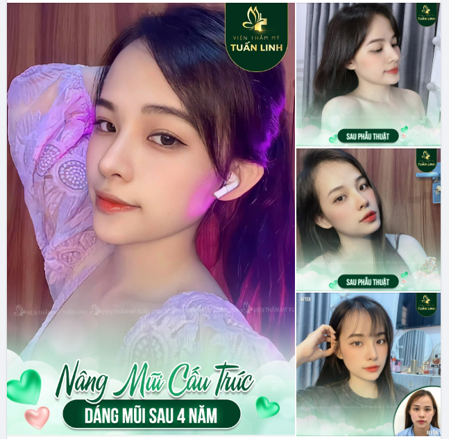 NÂNG MŨI CẤU TRÚC - DÁNG MŨI SAU 4 NĂM - ĐẸP HOÀN HẢO ĐẾN TỪNG CHI TIẾT!!