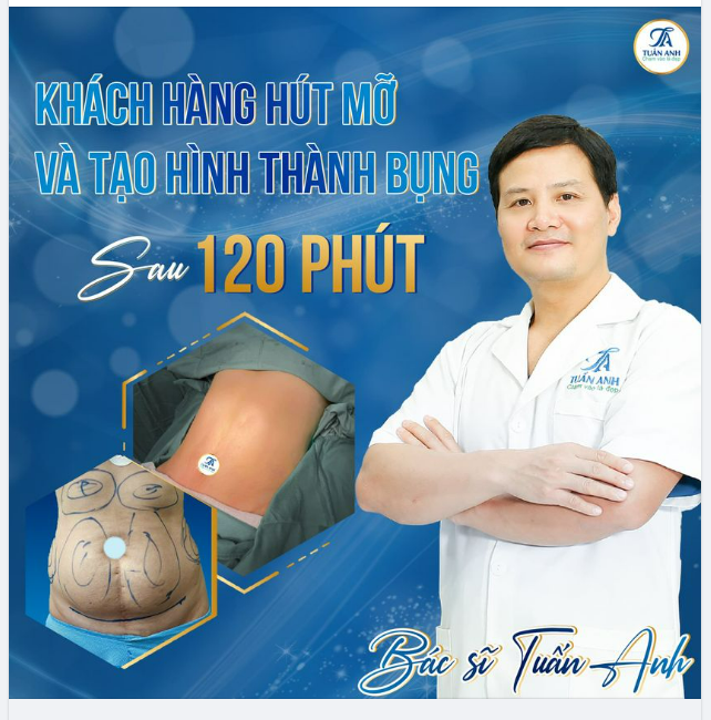TẠO HÌNH THÀNH BỤNG BS TUẤN ANH