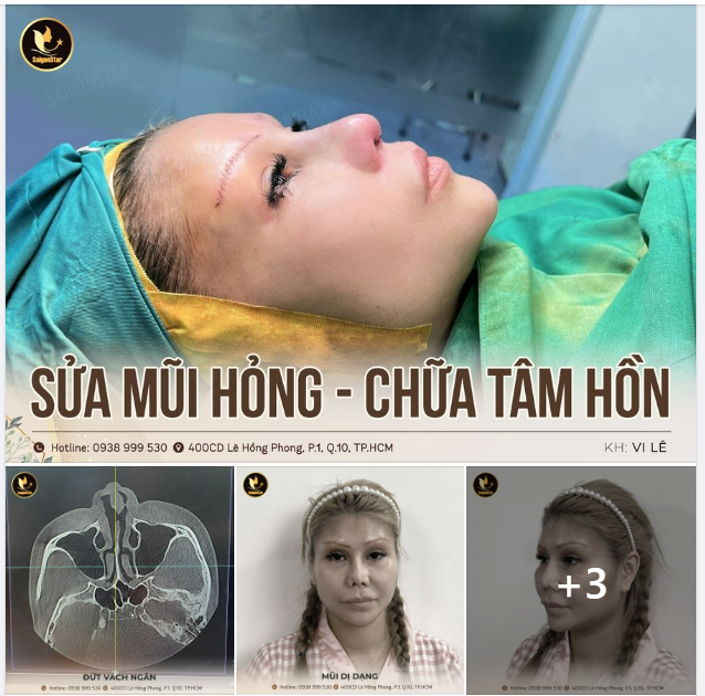 PHỤC HỒI MŨI DỊ DẠNG – ĐỨT VÁCH NGĂN