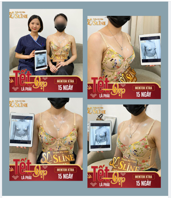 KẾT QUẢ NÂNG NGỰC TÚI XTRA SAU 15 NGÀY