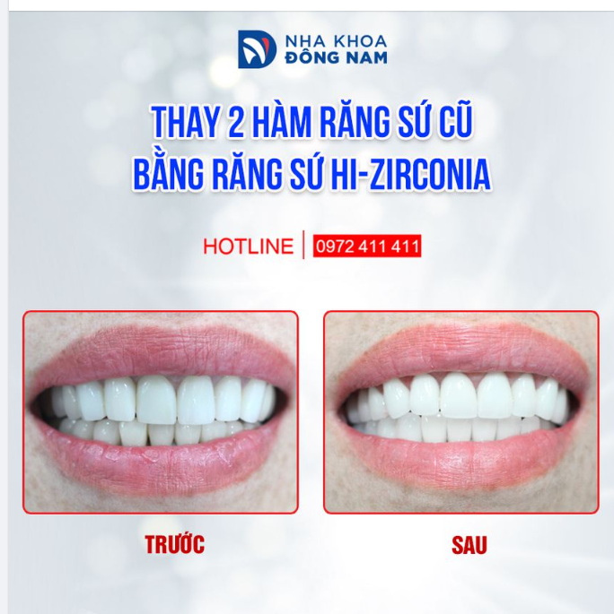 Đã từng làm răng nhưng không đẹp thì vẫn có thể làm lại.