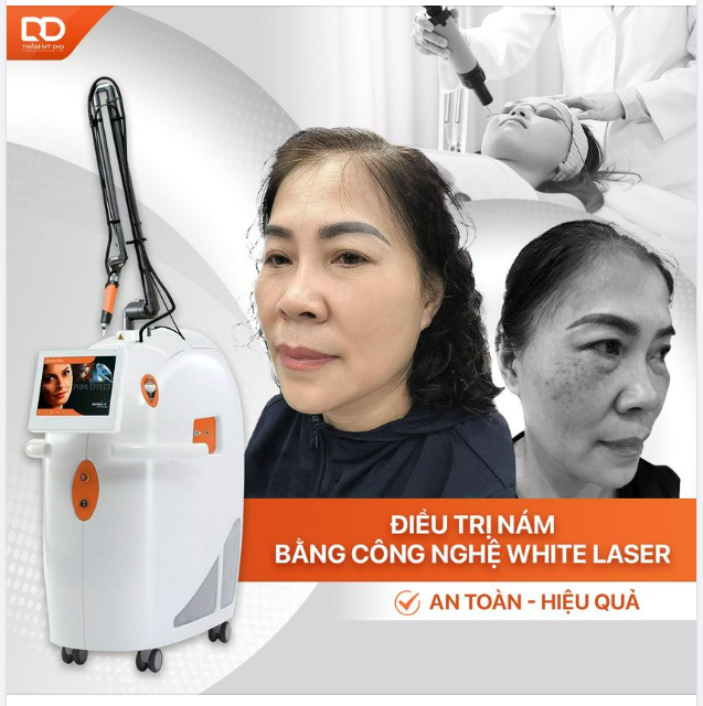 ĐIỀU TRỊ NÁM BẰNG CÔNG NGHỆ WHITE LASER AN TOÀN - HIỆU QUẢ.