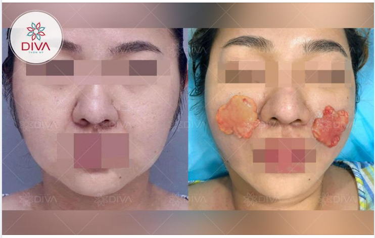 TÁCH TÚI MỠ MÁ TRONG THỰC HIỆN NHƯ THẾ NÀO?