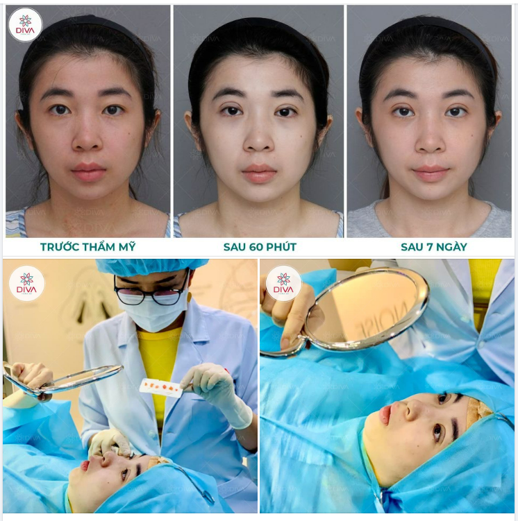 KẾT QUẢ THẨM MỸ MẮT 2 MÍ TỰ NHIÊN SAU THỰC HIỆN