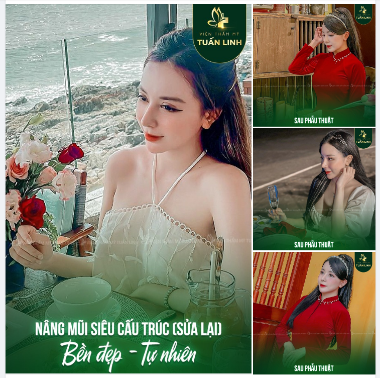 Nâng mũi siêu cấu trúc - Nâng độ phong cách thời thượng!