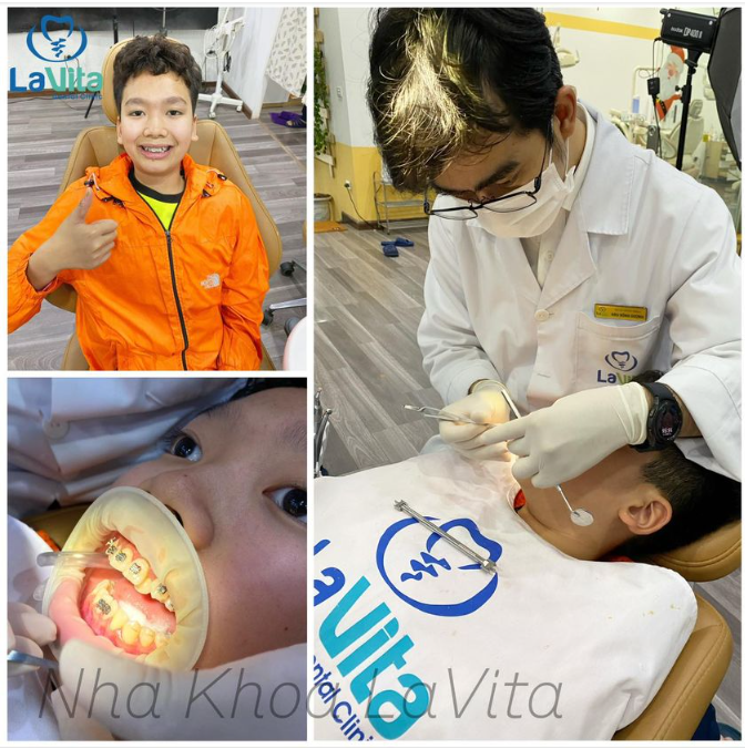 Bác sĩ nha khoa khuyên bệnh nhân nên đi niềng răng sớm, độ tuổi thích hợp là từ 12 đến 16 tuổi.