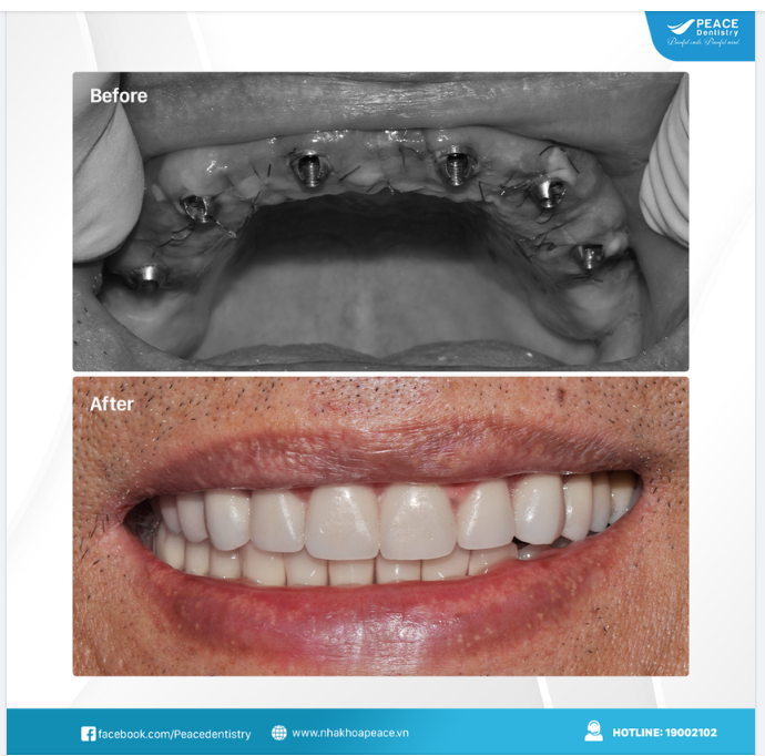 Trồng răng implant All on 6 thay thế hàm tháo lắp, khôi phục trọn vẹn chức năng ăn nhai (Hoàn thành sau 7 ngày)