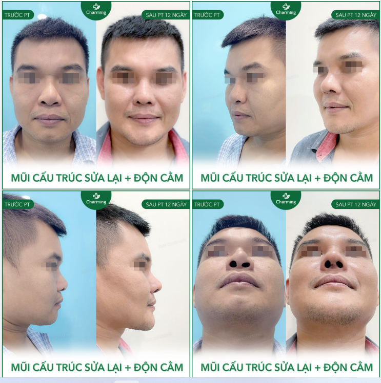 Chiếc mũi dù đã từng làm qua nhưng vẫn không đúng ý, không làm mũi thon gọn lại như mong muốn.
