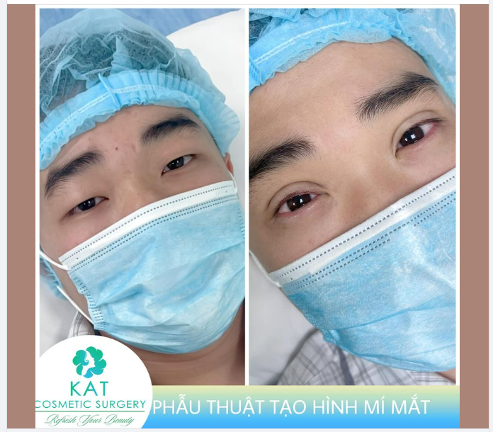 TẠO HÌNH MÍ MẮT Ở NAMM GIỚI ĐỆP BẤT NGỜ