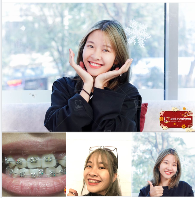 Tháo niềng đầu năm cho cô gái Hồng Nhung