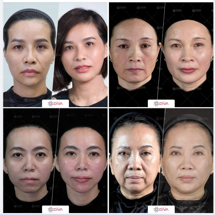 LÀM ĐẸP VỚI FILLER MD DYNAMIC CODES: KHÔNG SƯNG BẦM, KHÔNG NGHỈ DƯỠNG, ĐẸP NGAY SAU THỰC HIỆN