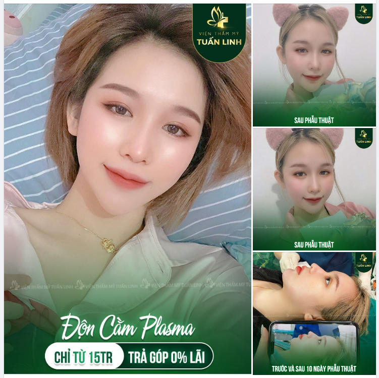 Cằm ngắn? ​​​​​​​ Độn cằm Vline ngay như cô gái này nhé - Giá chỉ 15TR - Có trả góp lãi suất 0%
