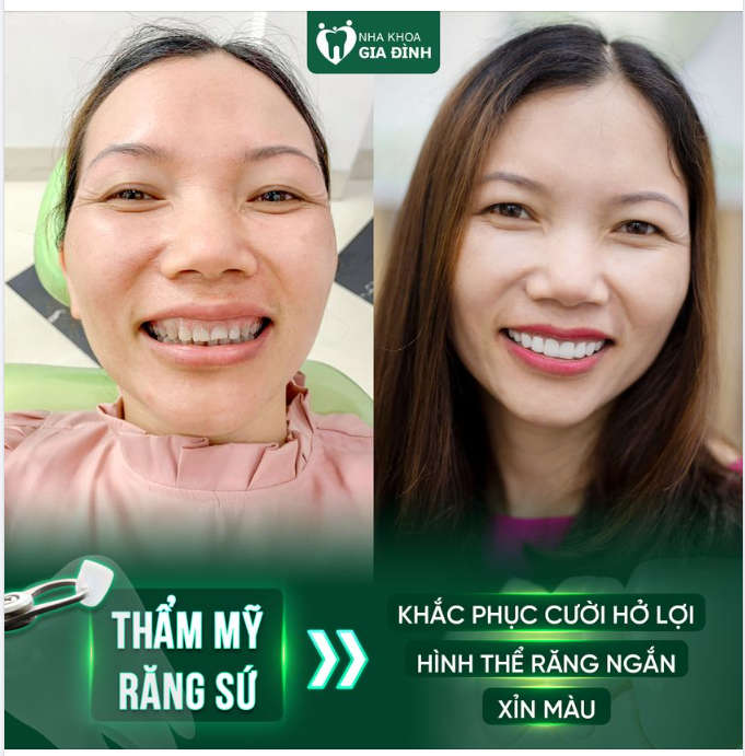 THAY ĐỔI NGOẠI HÌNH BẤT NGỜ SAU KHI THẨM MỸ RĂNG SỨ