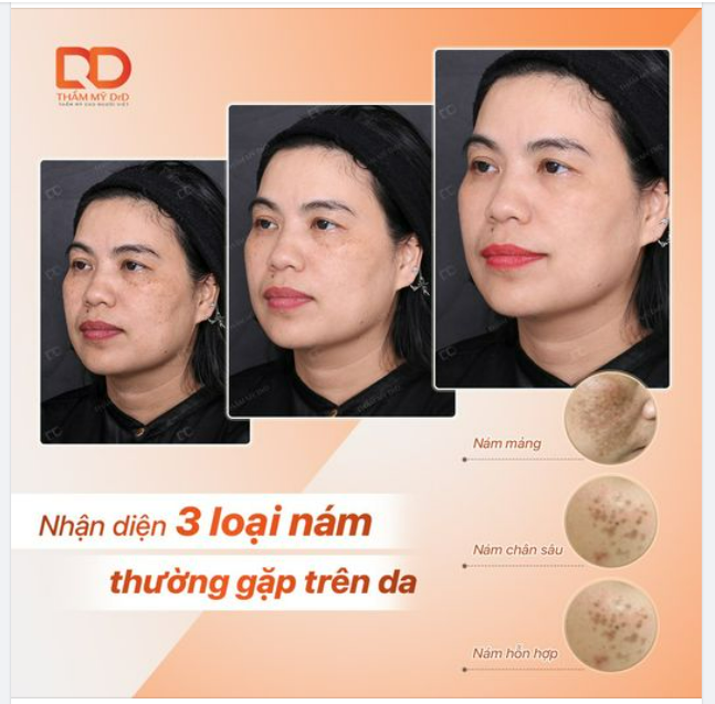 NHẬN DIỆN 3 LOẠI NÁM THƯỜNG GẶP TRÊN DA