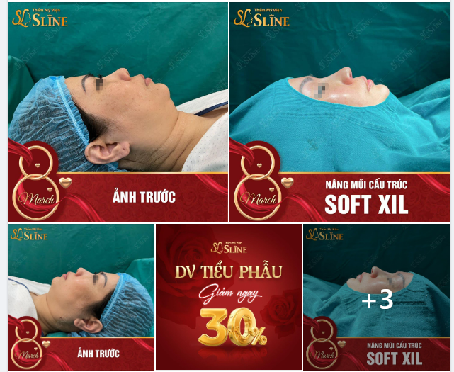 Feedback cực hút hồn từ KH sử dụng dịch vụ nângmũi