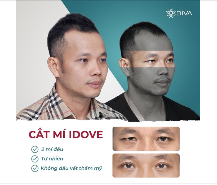 CẮT MÍ MẮT – MẮT 2 MÍ ĐỀU ĐẸP THU HÚT