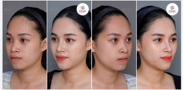 THÍCH VẺ ĐẸP TỰ NHIÊN, HÀI HÒA CÔ GÁI TÌM ĐẾN DIVA - KẾT QUẢ THẨM MỸ NHƯ THẾ NÀO?