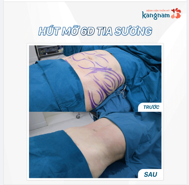 Cận cảnh sự thay đổi trước và sau hút mỡ bụng 6D Tia sương
