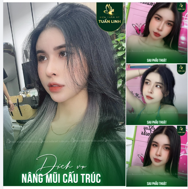 Tự tin hơn hẳn là điều 100% khách hàng nhận được sau nâng mũi!!