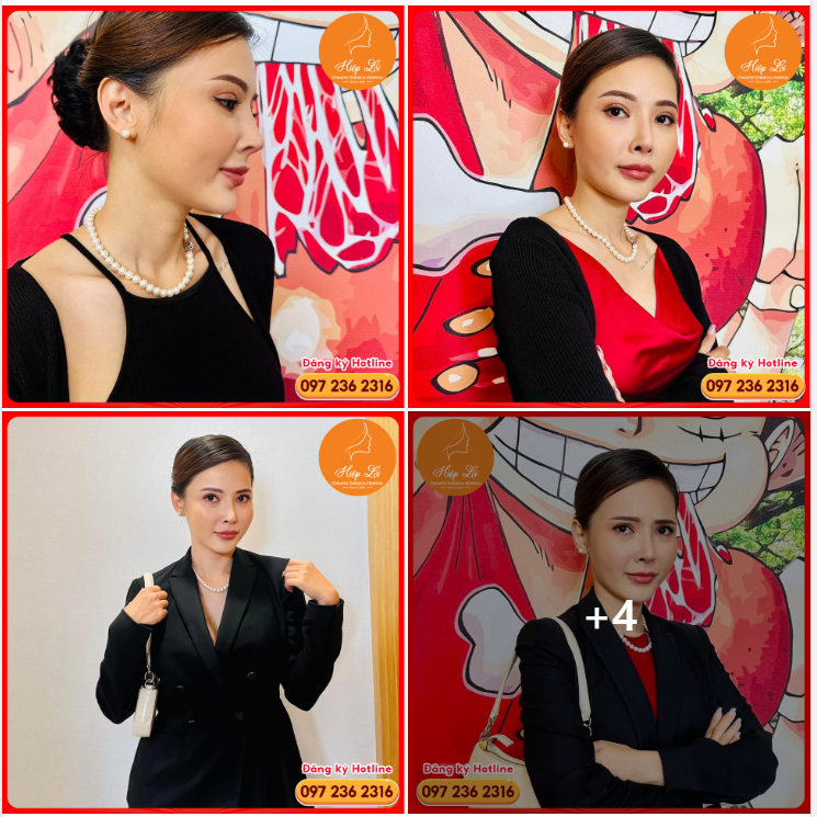 HOTGIRL 9X TUYẾT TRINH: ĐÃ TỪNG LỘ SÓNG MŨI - ĐẦU MŨI THỦNG - DA MŨI MỎNG VÀ CÁI KẾT!!!