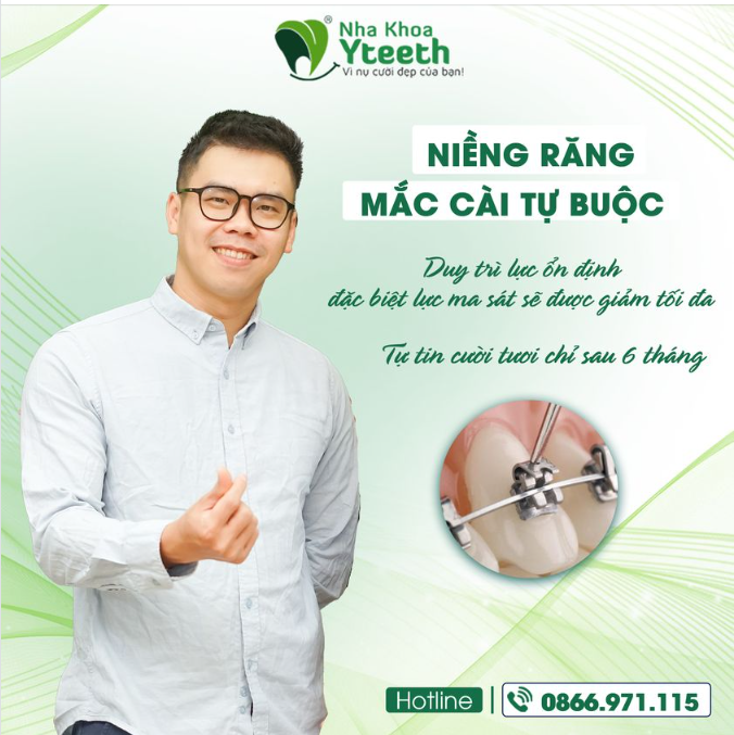 Niềng răng mắc cài tự buộc