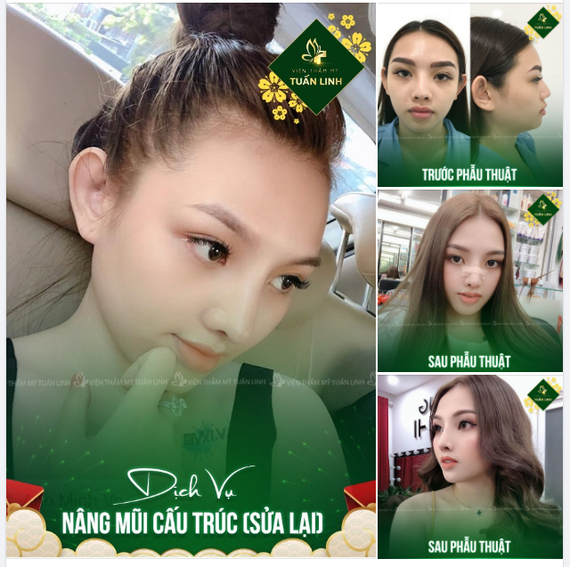 Mở bát” 2023 bằng một chiếc feedback hình ảnh nâng mũi cấu trúc (mũi sửa lại) của khách yêu nhà Tuấn Linh - Dáng mũi Angel line đẹp xuất sắc.