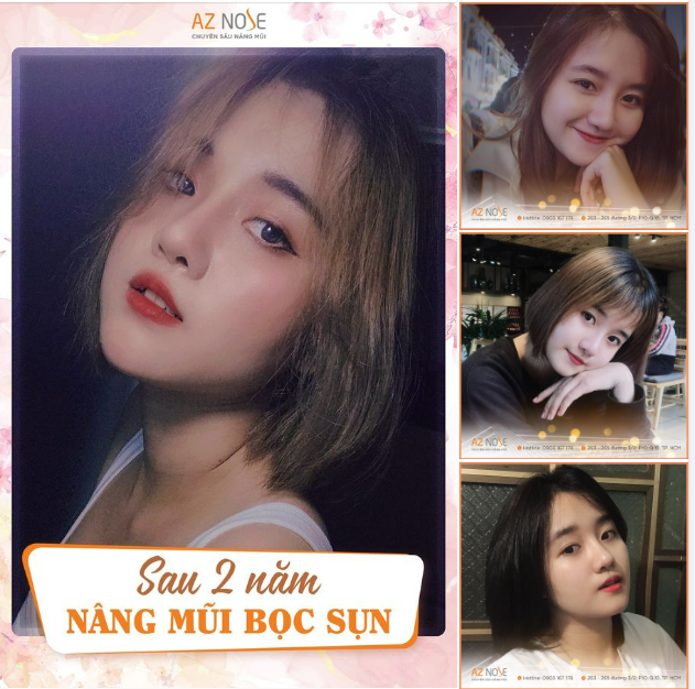 Gương mặt baby của nàng sinh viên sau 2 năm nâng mũi bọc sụn