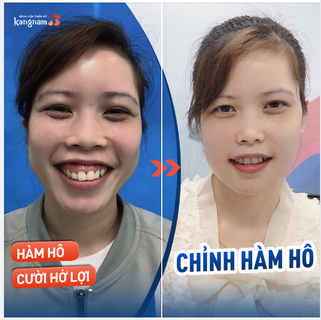 Chỉnh hàm hô - Chữa cười hở lợi