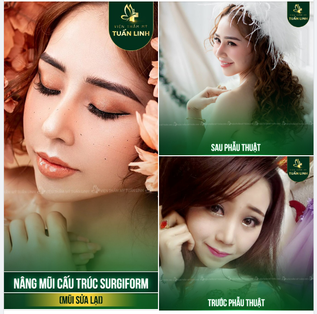 Đây là lí do vì sao bạn nên chọn nâng mũi tại Tuấn Linh ngay hôm nay!!