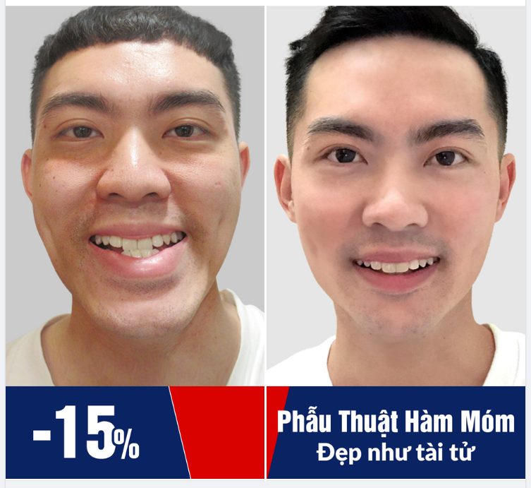 ĐẸP TRAI NHƯ TÀI TỬ SAU PHẪU THUẬT HÀM MÓM