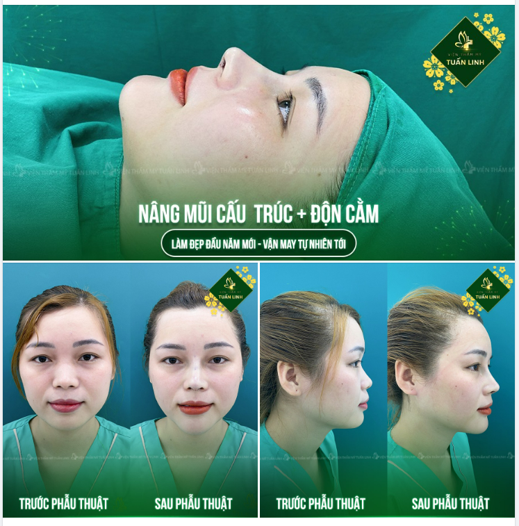 HẾT TẾT RỒI - LÀM ĐẸP LẠI THÔI COMBO NÂNG MŨI CẤU TRÚC + ĐỘN CẰM PLASMA SAU 90 PHÚT THỰC HIỆN!!